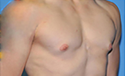 Gynecomastia Before and After Pictures Plano, TX