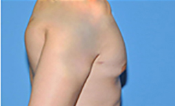 Gynecomastia Before and After Pictures Plano, TX