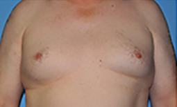 Gynecomastia Before and After Pictures Plano, TX