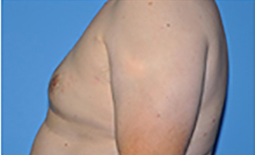 Gynecomastia Before and After Pictures Plano, TX