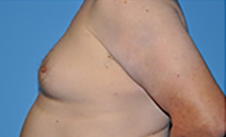 Gynecomastia Before and After Pictures Plano, TX