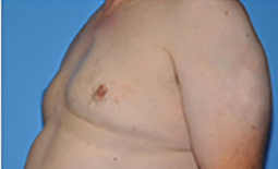 Gynecomastia Before and After Pictures Plano, TX