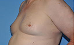 Gynecomastia Before and After Pictures Plano, TX