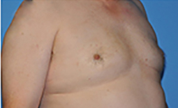 Gynecomastia Before and After Pictures Plano, TX