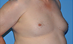 Gynecomastia Before and After Pictures Plano, TX