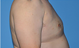 Gynecomastia Before and After Pictures Plano, TX