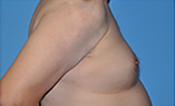 Gynecomastia Before and After Pictures Plano, TX