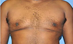 Gynecomastia Before and After Pictures Plano, TX