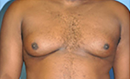 Gynecomastia Before and After Pictures Plano, TX