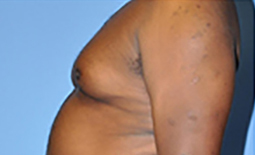 Gynecomastia Before and After Pictures Plano, TX