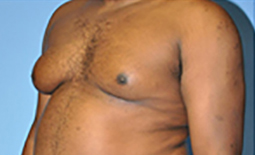 Gynecomastia Before and After Pictures Plano, TX