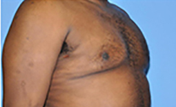 Gynecomastia Before and After Pictures Plano, TX