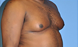 Gynecomastia Before and After Pictures Plano, TX