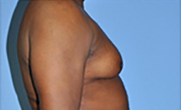 Gynecomastia Before and After Pictures Plano, TX