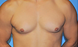 Gynecomastia Before and After Pictures Plano, TX