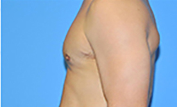 Gynecomastia Before and After Pictures Plano, TX