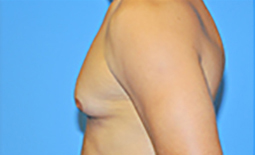 Gynecomastia Before and After Pictures Plano, TX