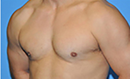 Gynecomastia Before and After Pictures Plano, TX