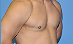 Gynecomastia Before and After Pictures Plano, TX