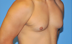 Gynecomastia Before and After Pictures Plano, TX