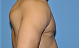 Gynecomastia Before and After Pictures Plano, TX