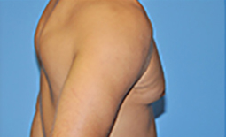 Gynecomastia Before and After Pictures Plano, TX