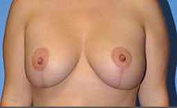 Breast Augmentation Before and After Pictures Plano, TX