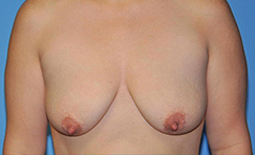 Breast Lift Before and After Pictures Plano, TX