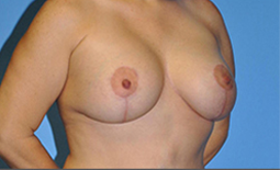 Breast Lift Before and After Pictures Plano, TX