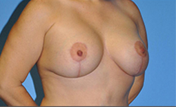 Breast Augmentation Before and After Pictures Plano, TX