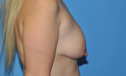 Breast Lift Before and After Pictures Plano, TX