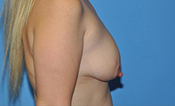 Breast Augmentation Before and After Pictures Plano, TX