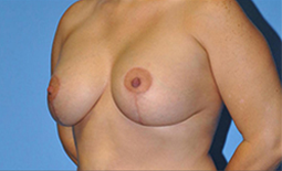 Breast Augmentation Before and After Pictures Plano, TX