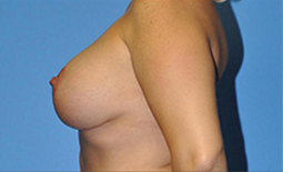 Breast Lift Before and After Pictures Plano, TX