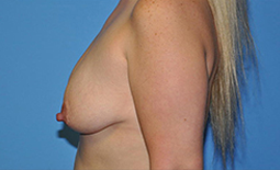 Breast Lift Before and After Pictures Plano, TX