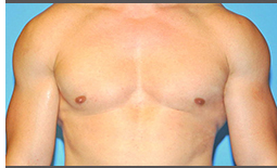 Gynecomastia Before and After Pictures Plano, TX