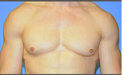 Gynecomastia Before and After Pictures Plano, TX