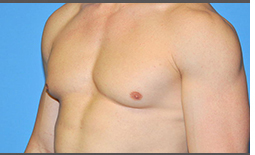 Gynecomastia Before and After Pictures Plano, TX