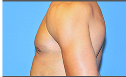 Gynecomastia Before and After Pictures Plano, TX