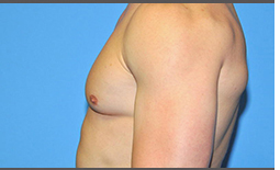 Gynecomastia Before and After Pictures Plano, TX