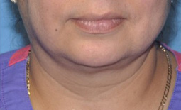 Kybella™ Before and After Pictures Plano, TX