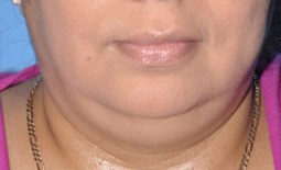 Kybella™ Before and After Pictures Plano, TX