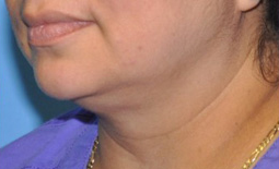 Kybella™ Before and After Pictures Plano, TX