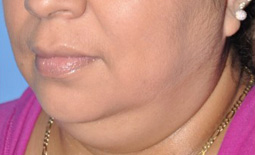 Kybella™ Before and After Pictures Plano, TX