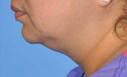 Kybella™ Before and After Pictures Plano, TX