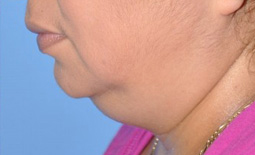 Kybella™ Before and After Pictures Plano, TX