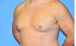 Gynecomastia Before and After Pictures Plano, TX