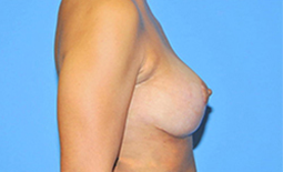 Breast Lift Before and After Pictures Plano, TX