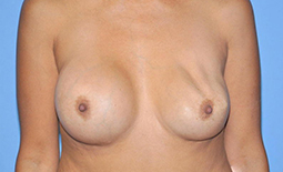 Breast Implants Before and After Pictures Plano, TX