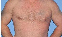 Gynecomastia Before and After Pictures Plano, TX